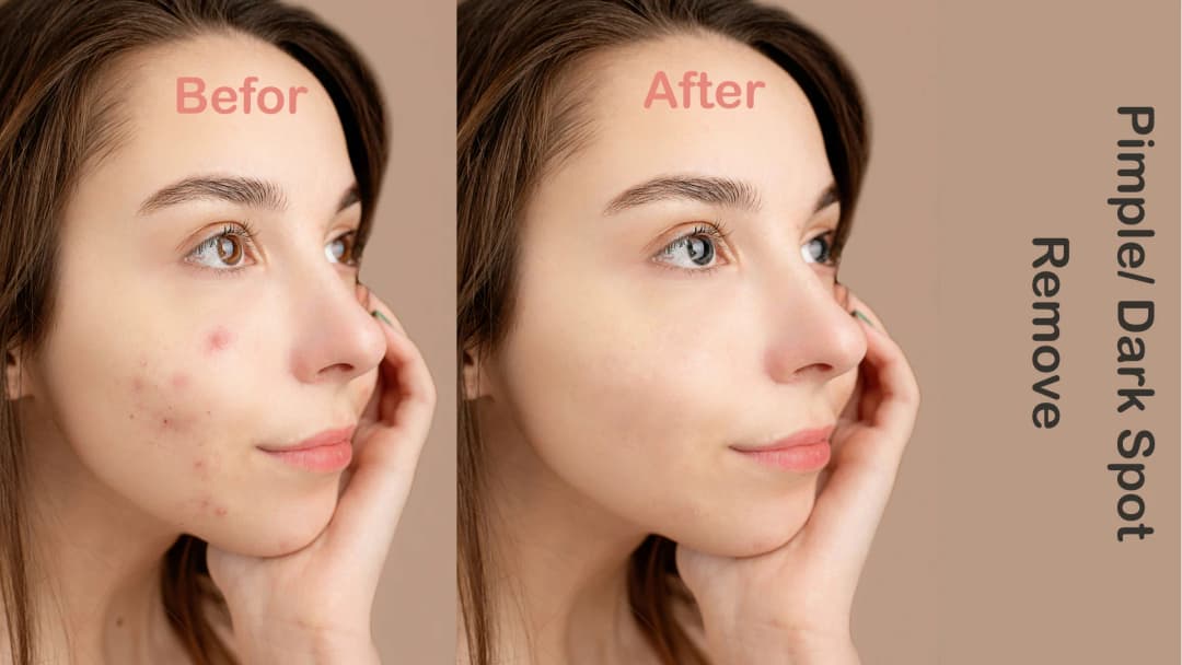 I Will Professionally Remove Dark Spots, Pimples, and Blemishes